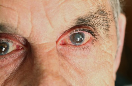 Age-related vision changes and conditions