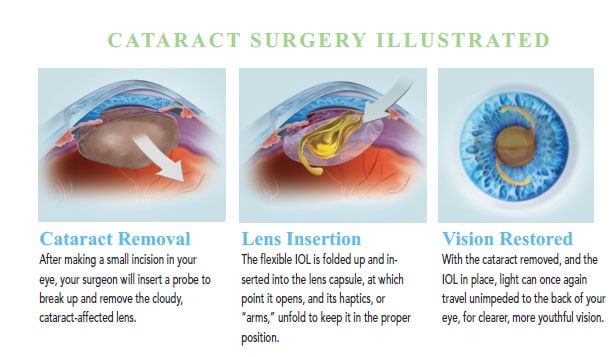 Cataract Surgery San Jose Cataract Surgeon Bay Area