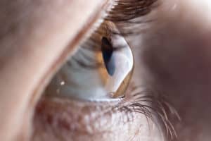 Keratoconus Bay Area CA