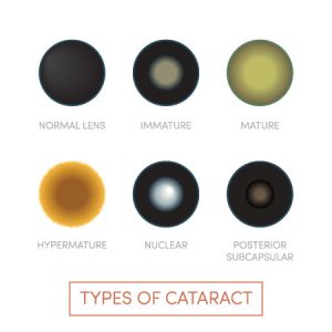 Cataract Surgery technology