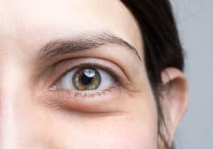 Woma nwith Monofocal vs Multifocal IOLs in the Bay Area