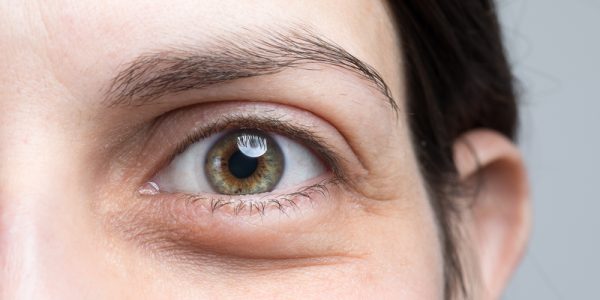 Woma nwith Monofocal vs Multifocal IOLs in the Bay Area