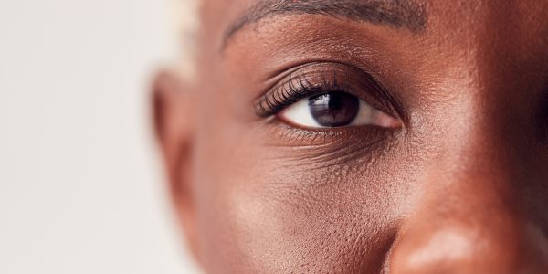 Close-up shot of a woman's eye post-LASIK surgery