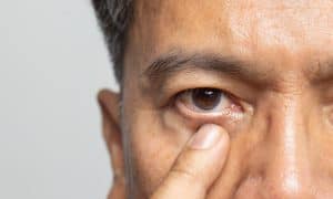 Close-up shot of a man's eye after IOL selection in San Jose, CA