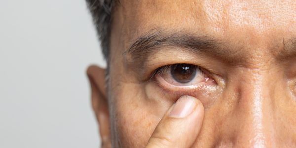Close-up shot of a man's eye after IOL selection in San Jose, CA